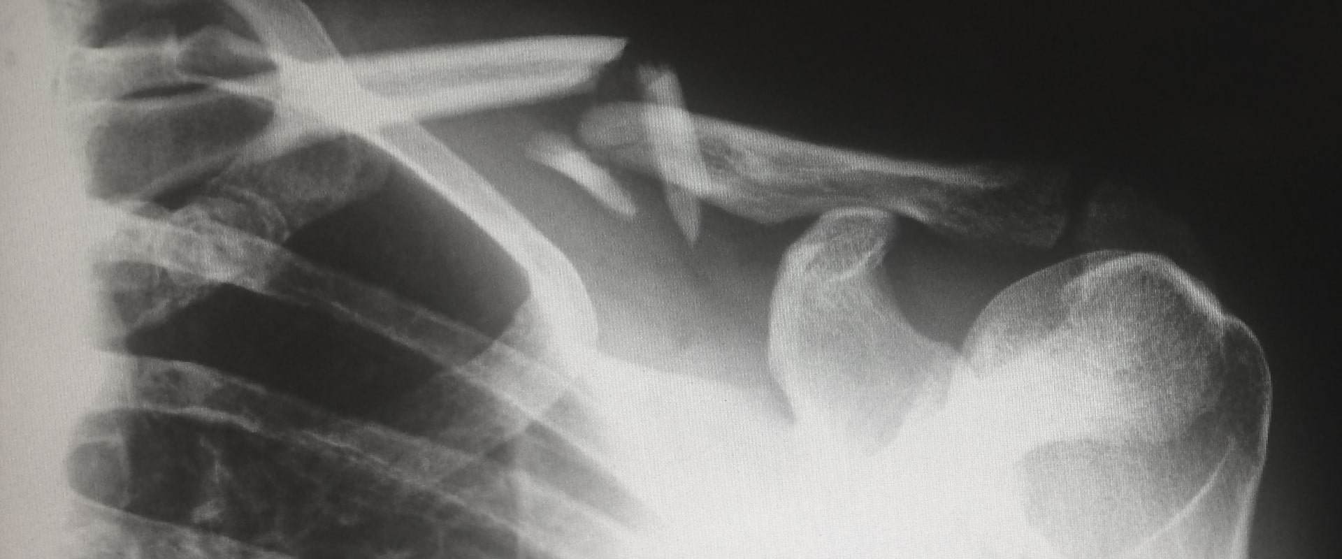 Broken Bones After a California Car Accident