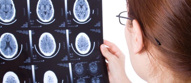 What Are Common Causes of Traumatic Brain Injuries in California? 